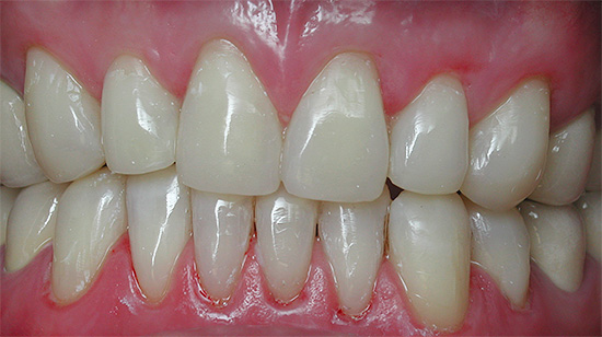 Les dents de devant après la restauration doivent être aussi naturelles que possible.