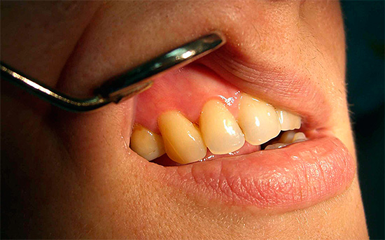 Dans la plupart des cas, le coût du traitement de la carie sur les dents antérieures est augmenté.