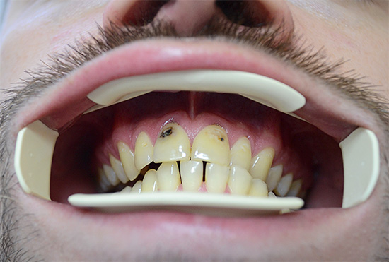 Una grave derrota de los dientes frontales por caries puede incluso causar complejos psicológicos.