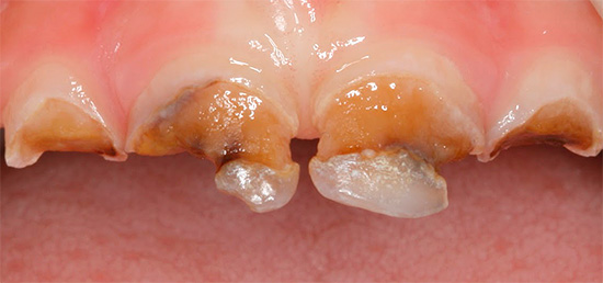 En cas de carie circulaire, la partie coronale de la dent peut un jour casser.