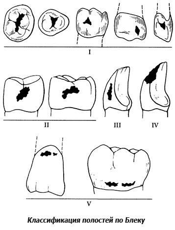 Classification de la cavité carieuse noire