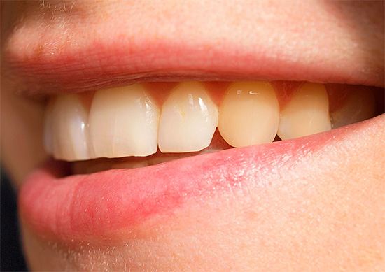 La complexité de la restauration des dents antérieures dépend en grande partie de leur état actuel.