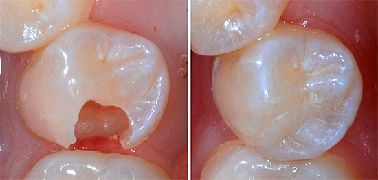 A la izquierda en la foto se muestra un diente con una cavidad formada, y a la derecha es la vista después de instalar el sello.