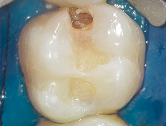 La aparición de materiales de relleno modernos ha reducido significativamente la cantidad de tejidos extirpados del diente en el tratamiento de la caries.