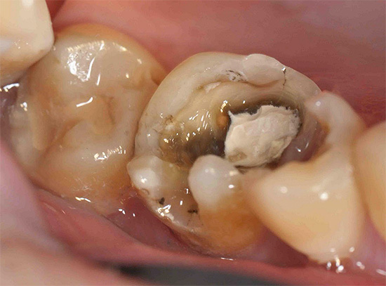En la mayoría de los casos, el tratamiento de la caries profunda es mucho más laborioso que durante las etapas iniciales de la caries dental.