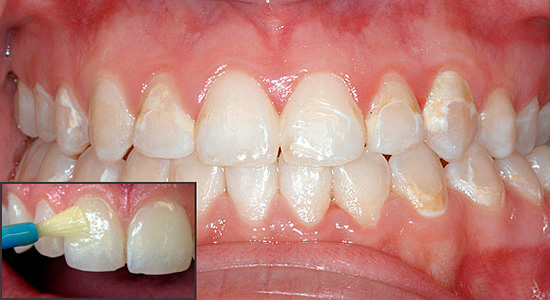 La thérapie reminéralisante permet de remplir l’émail des dents avec des composants minéraux et de restaurer ainsi ses propriétés originales.