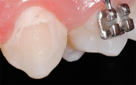 Une déminéralisation locale de l'émail peut se produire lorsque l'on porte un appareil dentaire.