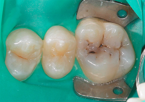 Foto de un diente con caries de fisura antes del tratamiento.