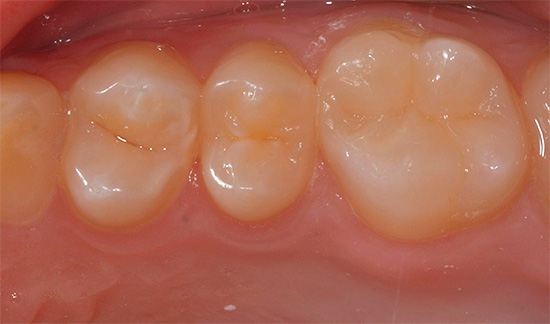 Y así es como se ve el mismo diente después de instalar el relleno usando el método de emparedado.