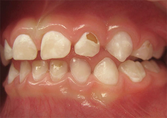 Si el tratamiento no se inicia a tiempo, el proceso de destrucción afecta gradualmente a los tejidos más profundos del diente ...