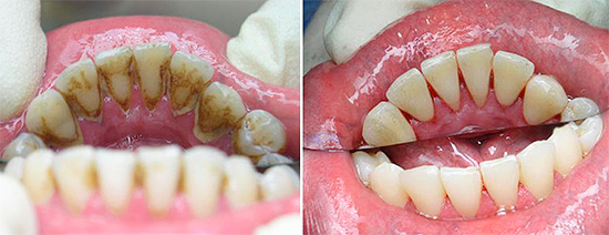 Avant la procédure de traitement, les dépôts de plaque et de minéraux sont retirés de la dent malade (et parfois de tous).