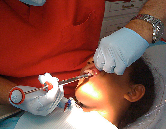 C'est comment l'anesthésie locale est effectuée pendant le traitement dentaire.