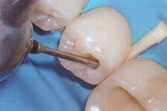 Une étape importante de la procédure est la préparation de la dent au cours de laquelle les tissus infectés et pigmentés sont enlevés.