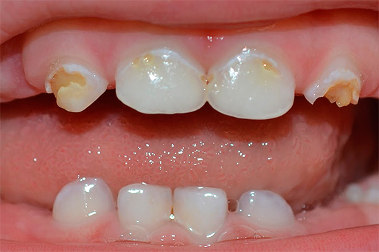 Un papel importante en la prevención de la caries en los niños se desempeña por medios especiales para la higiene bucal.