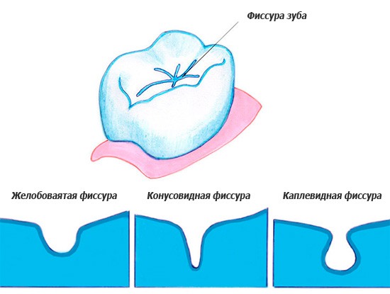 La imagen muestra las diferentes formas de fisuras dentales.