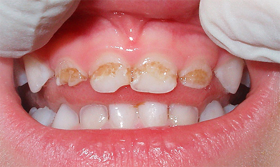 En la mayoría de los casos, la fuerte destrucción de los dientes de leche en un niño es en gran parte culpa de los padres que no prestaron la debida atención a las medidas preventivas.
