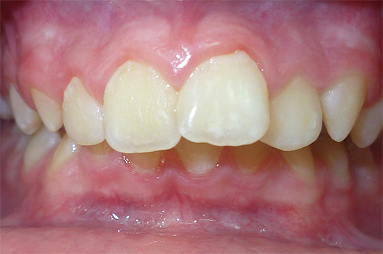 Las anomalías dentales y la mordida incorrecta a menudo contribuyen al desarrollo de caries.