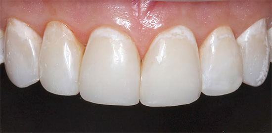 Caries iniciales en la etapa de la mancha blanca: en la zona cervical de los dientes, son visibles los focos de desmineralización del esmalte.