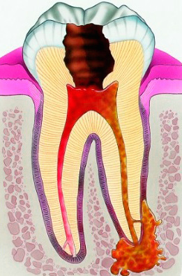 Au fil du temps, les pulpes peuvent se transformer en parodontite.