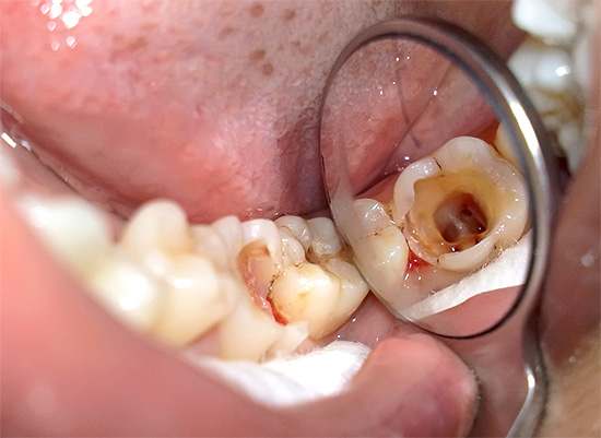 La photo montre les canaux radiculaires de la dent. Après le dépouillement, ils seront scellés.