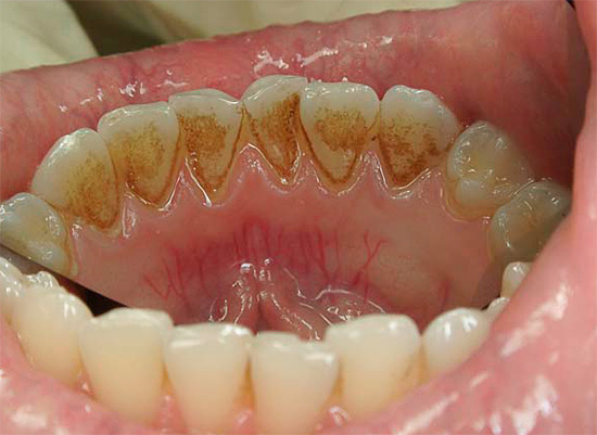 Les dents inférieures sont les plus sensibles aux dépôts minéraux en raison de leur lavage abondant à la salive.