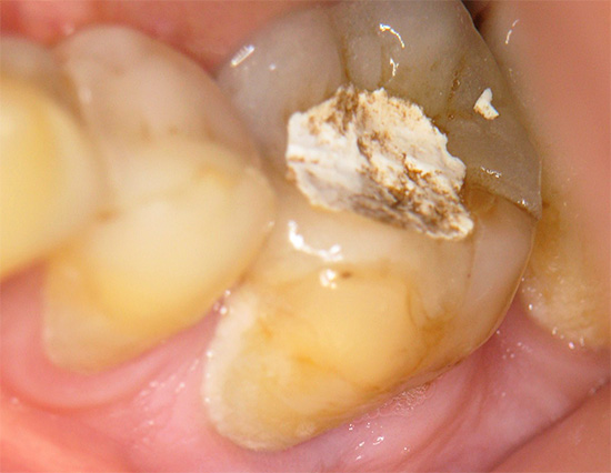 Obturation temporaire de la dent