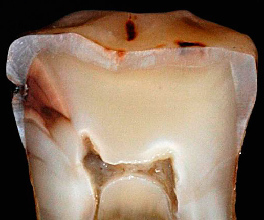 Dans la vraie section des dents, on voit clairement comment, au fil du temps, les caries profondes se propagent dans la chambre pulpaire.