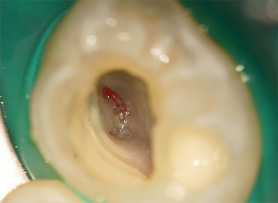 La photographie montre que lors de la préparation de la dent, la chambre pulpaire a été ouverte.