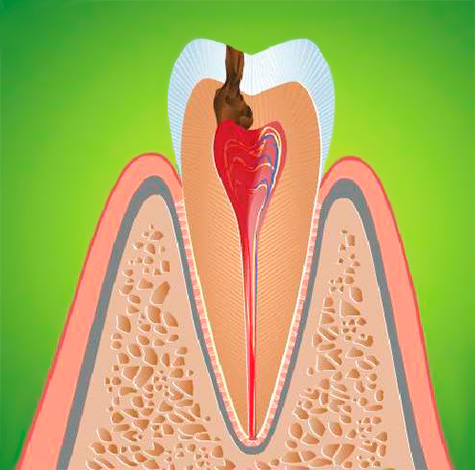 A inflamação dos tecidos moles na câmara pulpar do dente é acompanhada por todo um complexo de sintomas característicos, que examinaremos mais adiante.