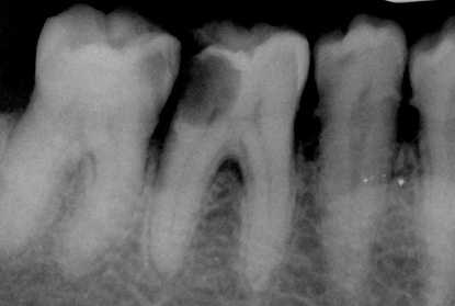 This x-ray clearly shows that the carious cavity reaches the pulp chamber.