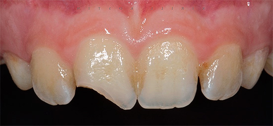 Cuando traumatismo severo en el diente a menudo desarrolla pulpitis traumática.