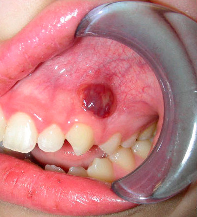Поток върху венците