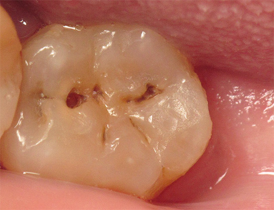 Sâu răng sâu như vậy bất cứ lúc nào có thể phức tạp do viêm tủy.