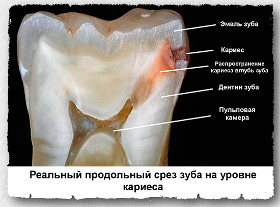Διαμήκης τομή ενός δοντιού που έχει προσβληθεί από τερηδόνα
