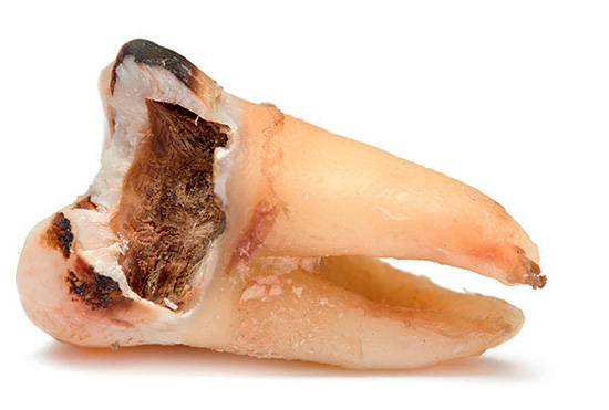 लुगदीकरण की विभिन्न जटिलताओं के साथ, दांत को अक्सर हटा दिया जाना चाहिए।