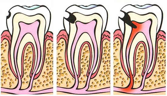 The picture shows schematically the development of caries up to pulpitis.