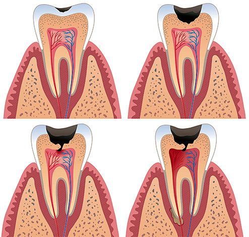 Se non si inizia il trattamento in tempo, il nervo del dente morto si decompone direttamente nella camera pulpare e l'infezione danneggerà i tessuti circostanti il ​​dente.
