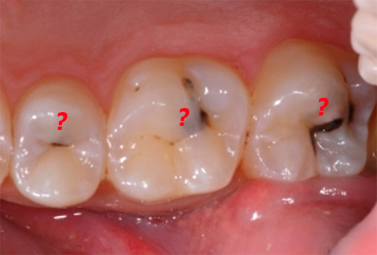 Con la pulpitis difusa, no siempre está claro qué tipo de diente provoca dolor agudo.