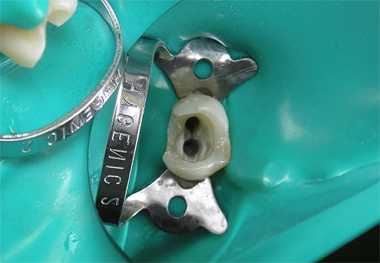 La foto muestra claramente la boca de los conductos radiculares del diente.