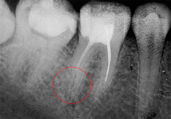 El canal dental, que no está completamente lleno, puede convertirse más tarde en una fuente de inflamación y dolor.