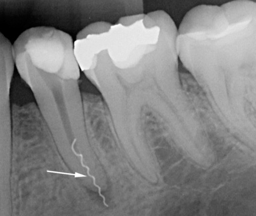 La foto muestra una pieza de instrumento dental roto en el canal.