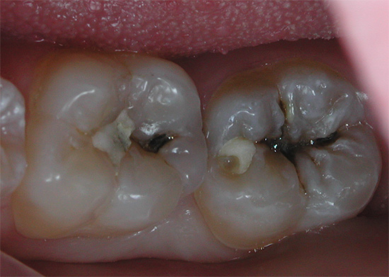 Το μάσημα των δοντιών με βαθιά τερηδόνα είναι ορατά, τα οποία θα αφαιρεθούν κατά τη διάρκεια της θεραπείας.