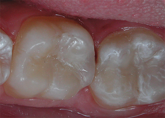 Y así se ven los mismos dientes después del tratamiento.