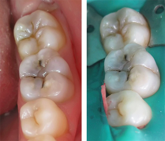 El impacto en un diente con un taladro y, especialmente, la extracción de un nervio de este es un tipo de intervención quirúrgica para eliminar el tejido infectado.