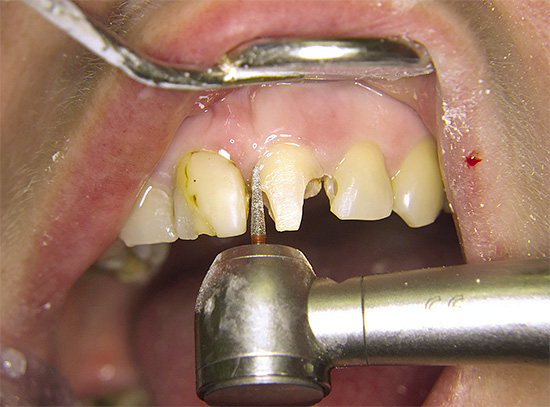 El impacto activo de la broca en el diente sin un enfriamiento adecuado puede provocar una quemadura de la pulpa.