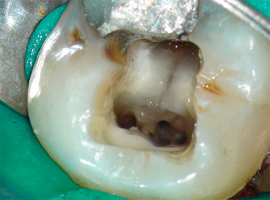 Ορισμένοι οδοντίατροι θεωρούν μικρό πόνο στο δόντι μετά την επεξεργασία και την πλήρωση των καναλιών ως απολύτως φυσικό και αποδεκτό.