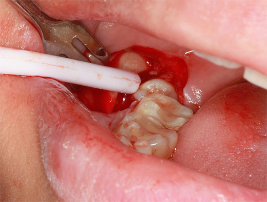O dente do siso exposto é visível na incisão feita.
