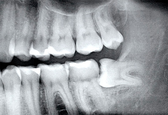 एक्स-रे स्पष्ट रूप से गलत तरीके से स्थित ज्ञान दांत दिखाता है (यह गमलाइन के नीचे छिपा हुआ है)
