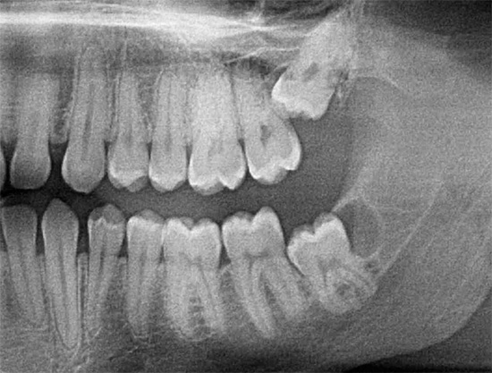 X-ray shows upper and lower wisdom teeth.
