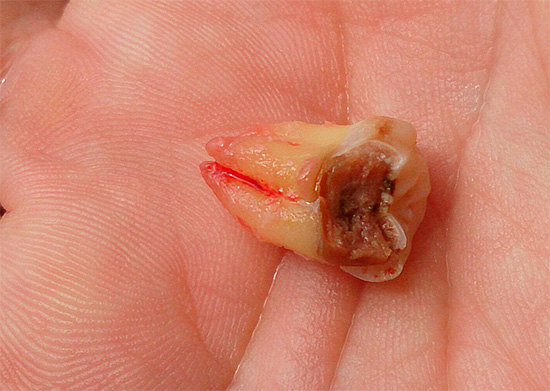 Ripped wisdom tooth